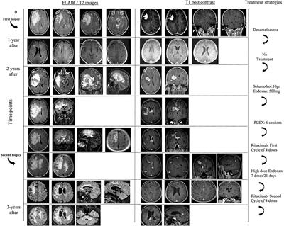 Recurrent Fulminant Tumefactive Demyelination With Marburg-Like Features and Atypical Presentation: Therapeutic Dilemmas and Review of Literature